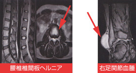 MRI検査で分かる主な整形外科の疾患